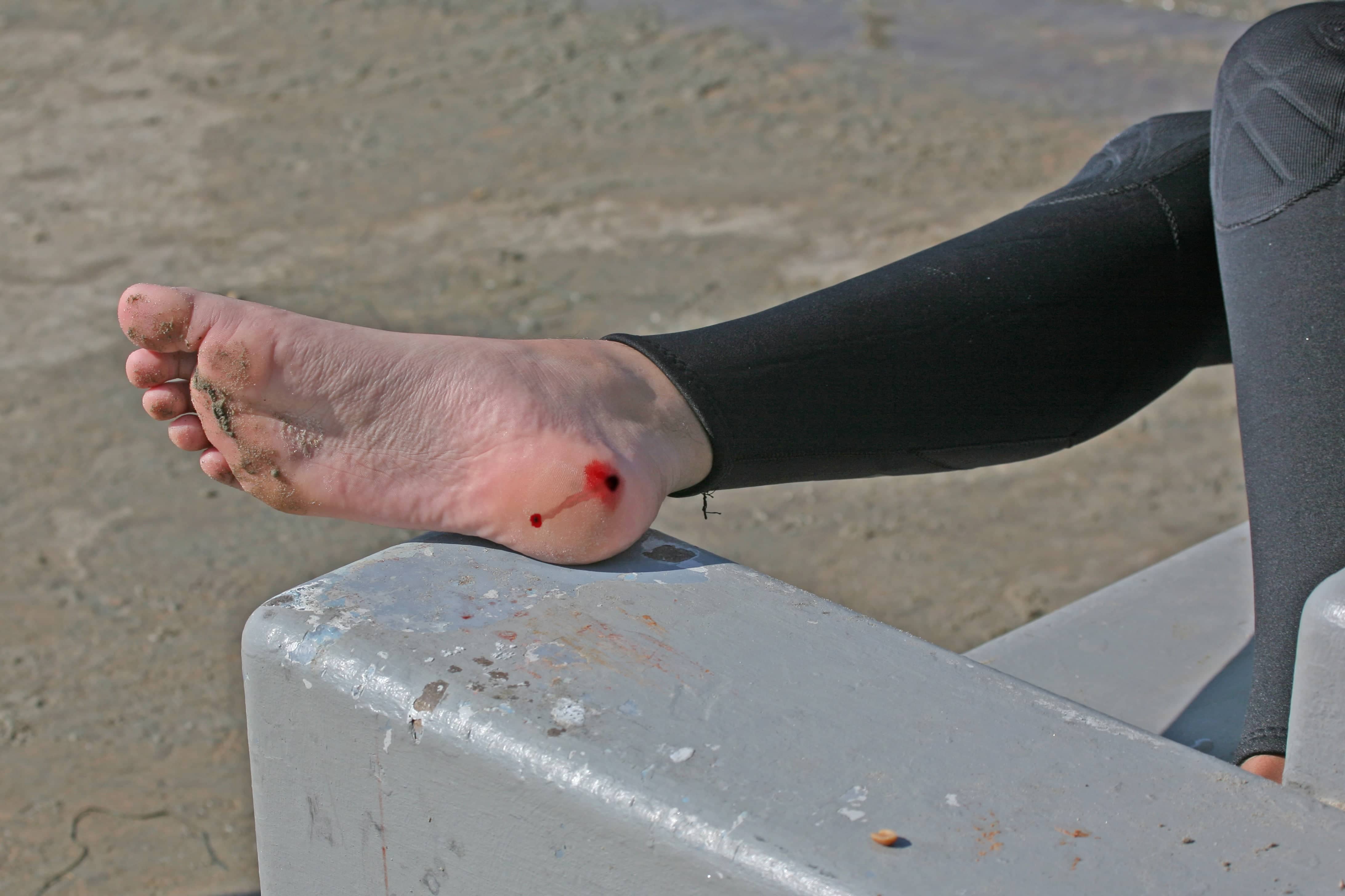 Stingray Experiences: What it's Like Getting Stung